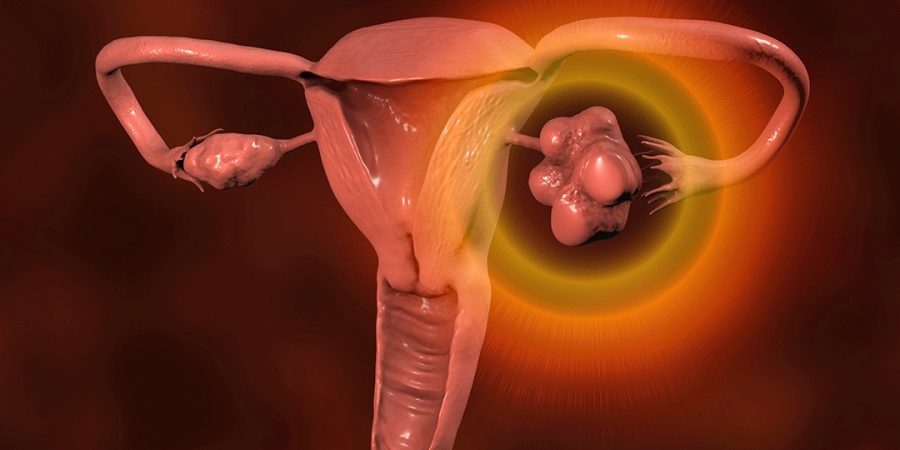 Qual a diferença entre endometriose e ovários policísticos?