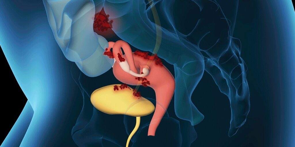 Endometriose na bexiga: conheça os tratamentos